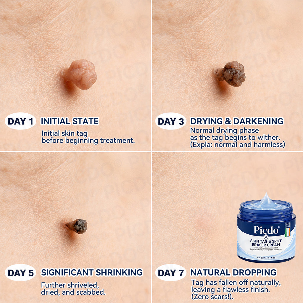 7-Day Skin Tag & Spot Eraser Cream — Gentle, Targeted Care for Smoother-Looking Skinc🌈