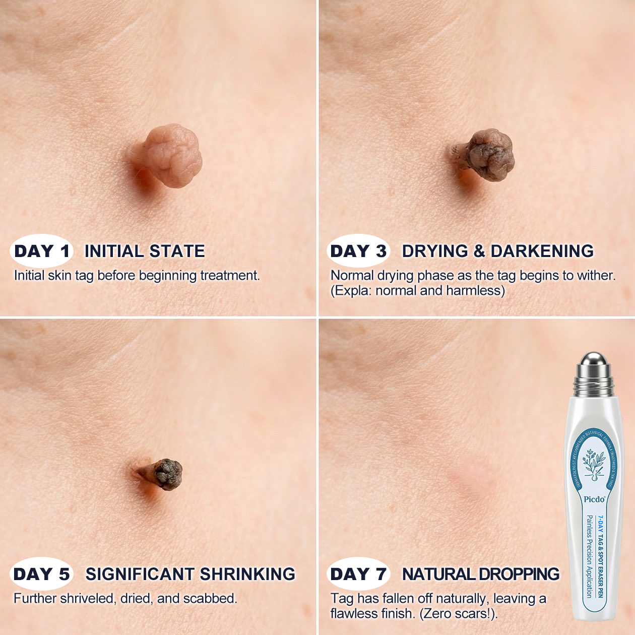 𝐏i𝐜𝐝o® 7-𝐷𝑎𝑦 𝗧𝐚𝐠 & 𝗦𝗽𝐨𝐭 𝐄𝐫𝒂𝒔𝒆𝒓🪄(Zero Pain, Zero 𝐒𝐜𝐚𝒓𝒔 Rollerball)💥