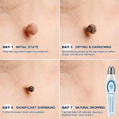 𝐏i𝐜𝐝o® 7-𝐷𝑎𝑦 𝗧𝐚𝐠 & 𝗦𝗽𝐨𝐭 𝐄𝐫𝒂𝒔𝒆𝒓🪄(Zero Pain, Zero 𝐒𝐜𝐚𝒓𝒔 Rollerball)⭐